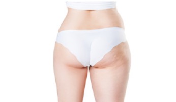 Mesoterapia