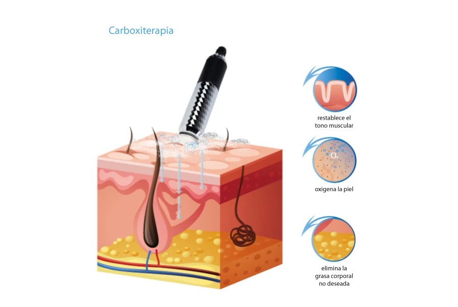 Carboxiterapia para la reducción de ojeras