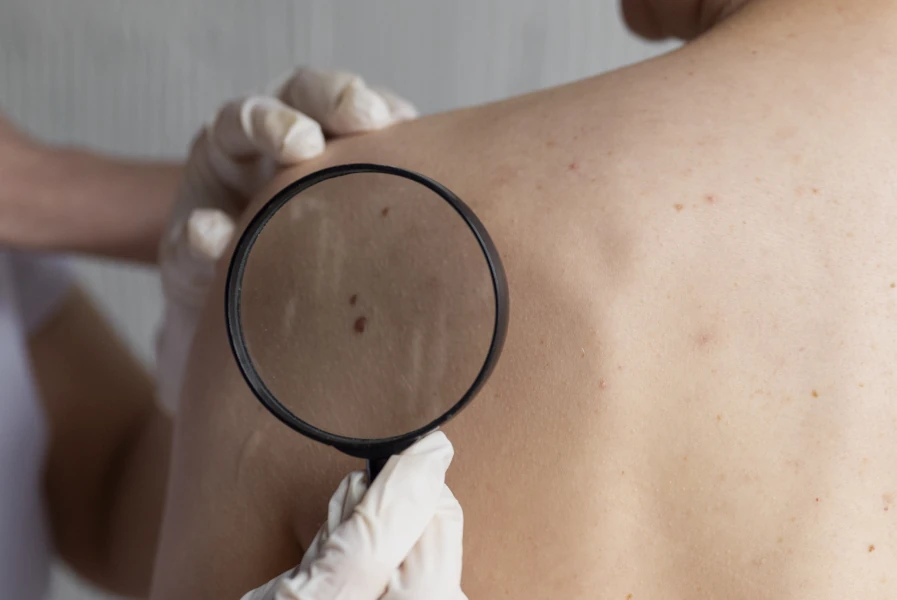 Eliminación angioma en cereza, angioma de cereza o punto rubí