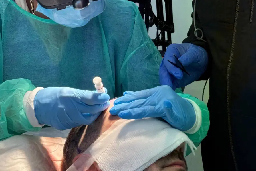 Implantación de los folículos pilosos en un paciente sometido a injerto capilar