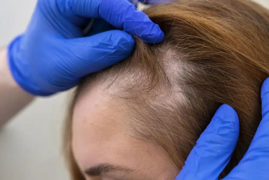 El Microinjerto capilar Long Hair puede devolverte la densidad y vitalidad de tu cabello sin cambios drásticos