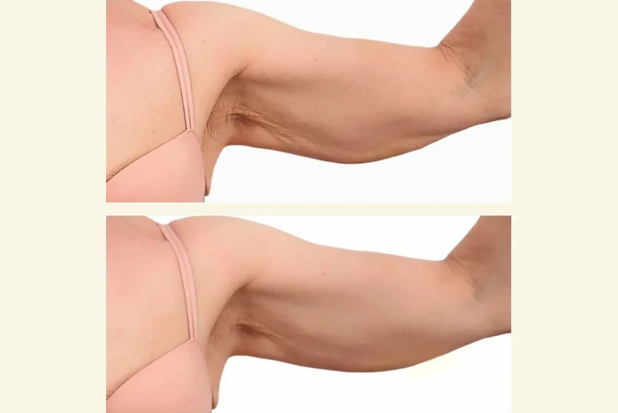 Reafirma y Remodela tu Silueta Con Lanluma y Sculptra