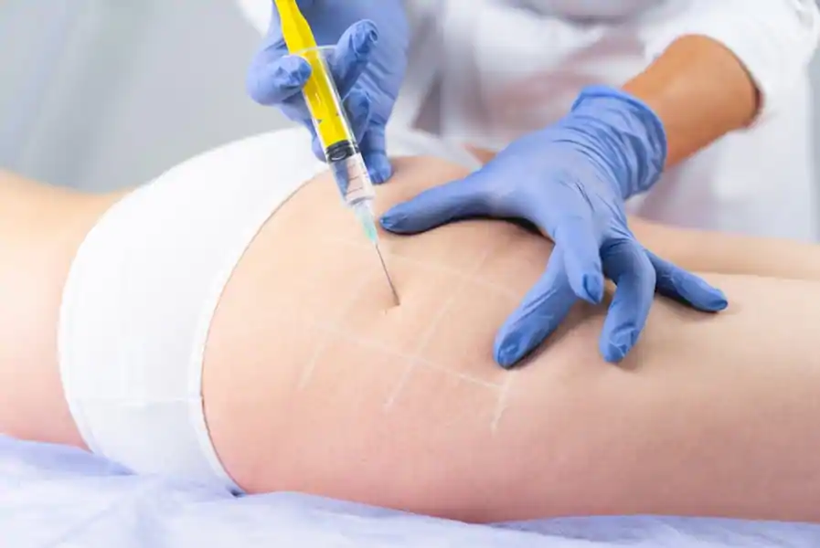 Tratamiento Alidya anti celulitis en Zaragoza 2